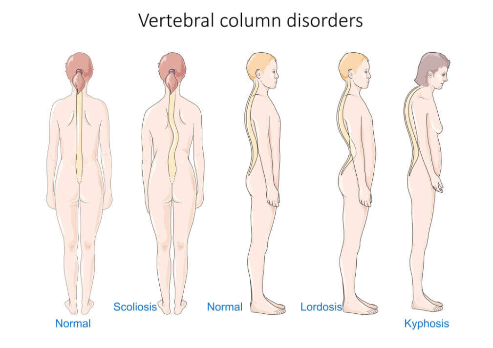 scoliosis